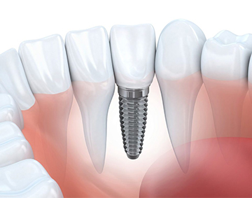 restorative dental care - Horizon Dental